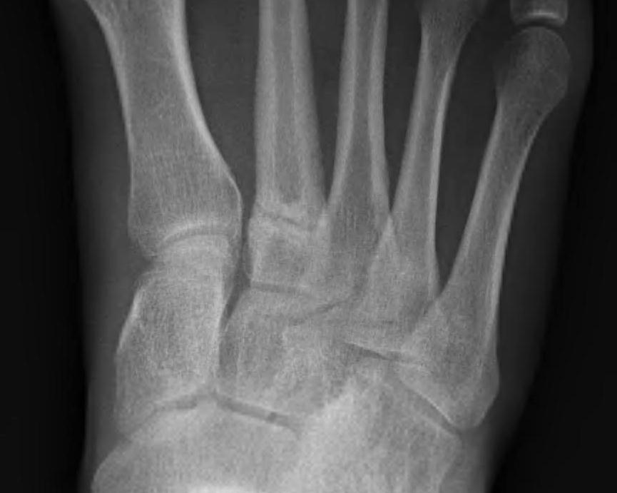 Second Metatarsal Stress Fracture
